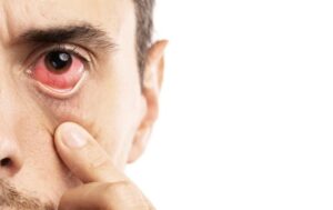 Eye Flu Conjunctivitis victim
